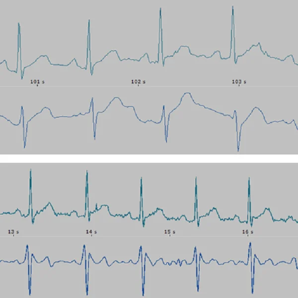 Bioimpedance Cardiovascular Study